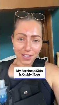 My Forehead Surgery Saved My Face 🤯 #dogbiterecovery, #foreheadsurgery, #plasticsurgery,#storytime