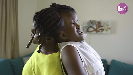 Conjoined twins attached at the head can never be separated