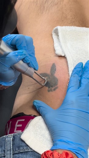 The END of this video and the progress 😍 ✨ Laser Tattoo Removal — What’s Normal After Treatment ✨ 🍑 yes… We even take care of those butt cheek tattoos, no judgment here! 😉 Thinking about getting a tattoo removed? Here’s what to expect right after your session 👇 The outline of the tribal is the 3rd treatment and the first treatment on the playboy bunny! 💨 Frosting: A white or grayish haze that appears immediately after treatment — totally normal and fades within minutes. 🔴 Redness & Swellin