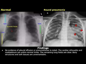 Chest X-Ray Pneumonia Reporting | How To Write CXR Reports | Clinical History, Findings & Impression