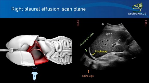 Pleural effusion: The ‘Spine sign’