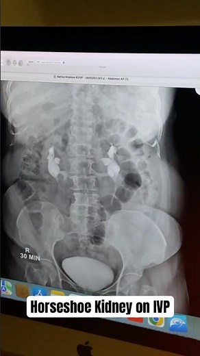 Visualizing the unique anatomy of a Horseshoe Kidney through Intravenous Pyelogram (IVP).