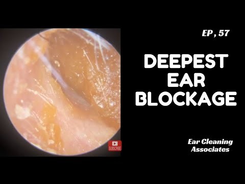 Extreme Dry Skin & Keratin Plugs Removed from the Ear Canal - EP 57