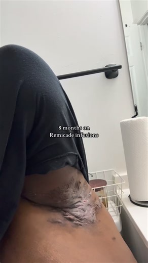 Tomorrow marks 10 months on Remicade — 10 months of fighting, hoping, and holding on. Each infusion brings me one step closer to living more freely, to spending less time in hospital rooms and more time in the moments that remind me why I keep going. The pain is still there, the fight is still real, but I’m learning to take it one day at a time with faith, patience, and gratitude. Here’s to another treatment, another chance, another reminder that healing isn’t linear — but it’s still happening. 