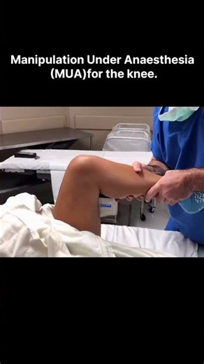 Knee Manipulation Under Anaesthesia (MUA) | Knee Stiffness Treatment After Surgery | Physiotherapy