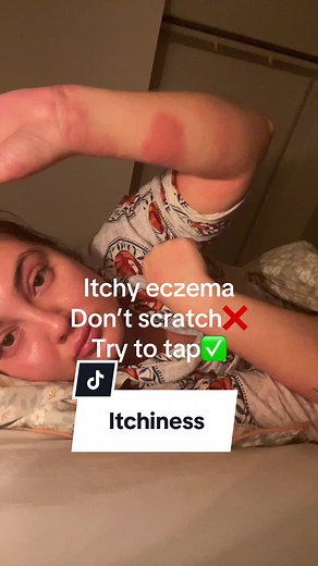 Managing Eczema Itch: Tapping vs. Scratching