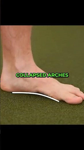 Your collapsed arch is actually a big toe problem #nervoustystemtraining #recovery