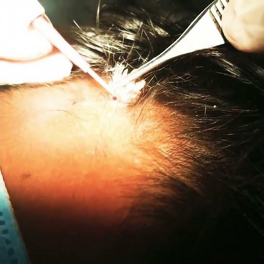 Wart removal - Dr Amit Mohan