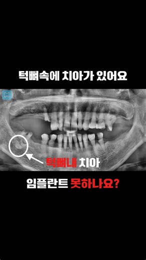 #임플란트 #평택임플란트 #평택치과 #구강악안면외과 #구강악안면외과전문의 #고난도임플란트