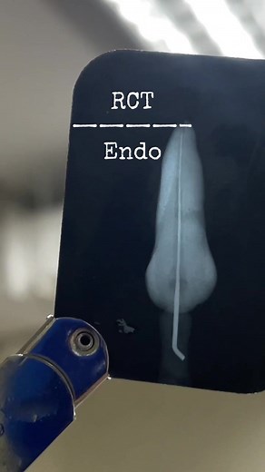 What is root canal treatment? #studentista #studentist #rootcanaltreatment #dentistryworld #dentistanotiktok #studentistangkaladkaren