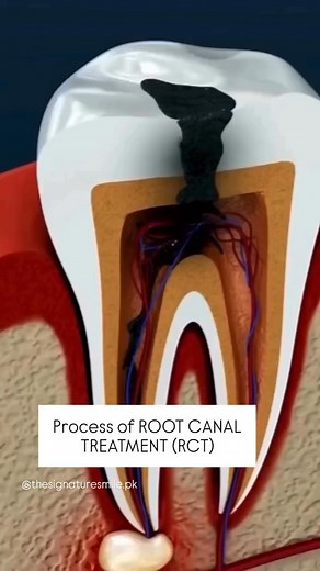 THE SIGNATURE SMILE on Instagram: "A root canal is a dental procedure to save a severely decayed or infected tooth. If you are witnessing symptoms like sensitivity, pimple on gums, chipped or cracked tooth, swollen jaw, consult a professional immediately. #dentistry #rootcanal #rct #guttapercha #pulpremove #cleaning #hygiene #bacteria #infection #dentist #anesthesia #procedure #filling"