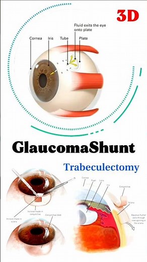 GlaucomaShunt #medical #animation #3d #short | biology with Aliya
