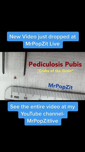 You can see the whole story at my YouTube channel - mrpopzitlive this patient was misdiagnosed with eczema, but asking the right questions and doing a thorough exam got me to the correct diagnosis. #dermatology #physicianassistant #dermatologypa #mrpopzit #mrpopzitlive #medicaleducation #youtuber #youtube #bodylice #pubiclice #crabs