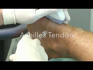 OSTENIL® Tendon injection 1/4: Achilles Tendon