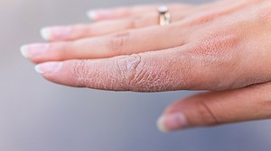Experiencing Dry And Peeling Skin This Winter? Watch Out For These Underlying Medical Conditions