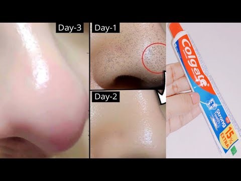 How to remove blackheads with toothpaste | Colgate for blackheads | Colgate on blackheads overnight