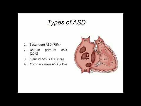 Sinus Venosus Atrial Septal Defect