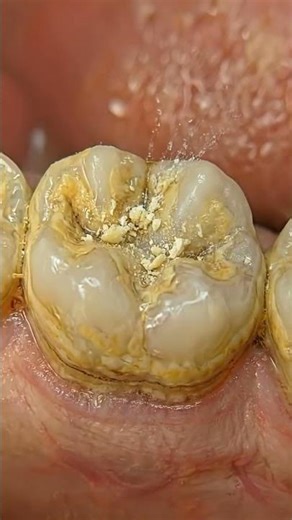 Enamel Surface Cleaning: The Ultimate Dental Hygiene Process 🦷✨ #toothcleaning