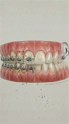 Invisalign vs Braces 🦷 Which Is Better for You? #dentist #toothcraft