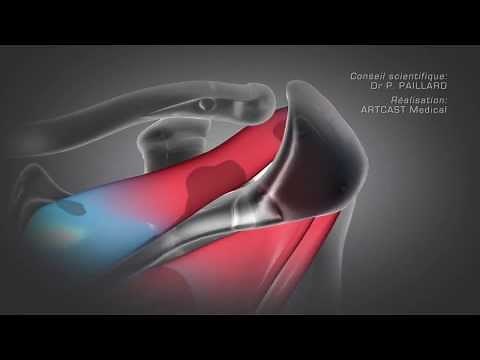 Arthroscopie de l'épaule : Acromioplastie