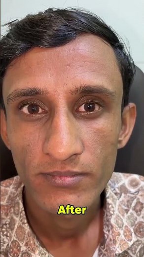 One Eye Squint Surgery That Restored Vision & Confidence A Rajasthan Patient’s Story