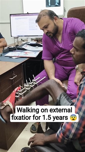 😱Open fracture-walking on fixatior from 18 months