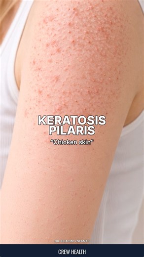 Keratosis Pilaris “Chicken skin” 👨🏻‍⚕️☝🏼💥