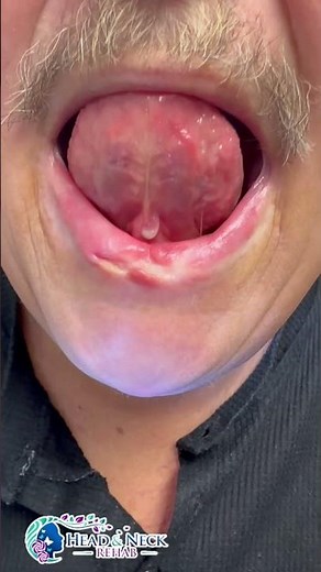 Lip Cancer and Swelling