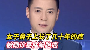 女子鼻子上长了几十年的痣，近一年内逐渐变大，洗脸碰到还反复出血 被确诊基底细胞癌，医生：少数痣可能在长期日晒 反复摩擦，或遗传因素等影响下发生恶变