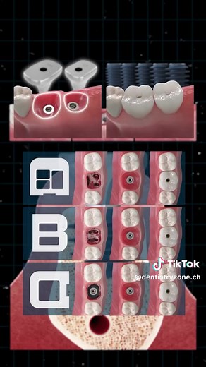 Immediate Dental Implant Placement at Molars: MegaGen Simplifying Challenges