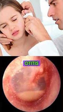 Cómo sé si tengo otitis media aguda #otitismedia #diagnostico #drwilsondelgado #bacteriana #oído