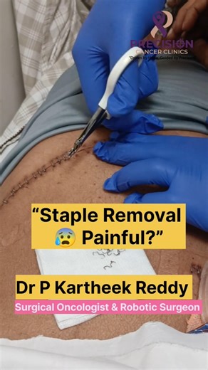 Stapler Removal After Surgery | Painful or Not? Surgical Staples Removal Explained