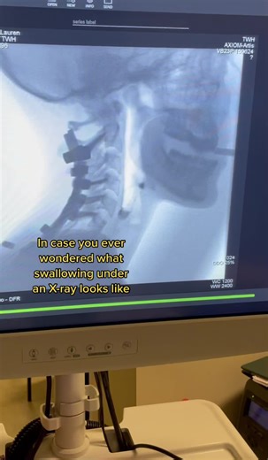 Swallowing X-Ray: Barium Swallow and Dysphagia Explained