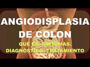 Angiodisplasia de colon: Qué es, diagnóstico y tratamiento