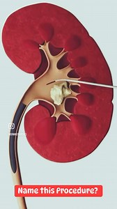Name this Procedure | Medical Talks