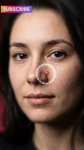 The Hidden Danger of Popping Pimples on Your Face