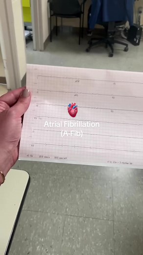 –Atrial Fibrillation– 🫀Also called “A-Fib”, this rhythm is an uncoordinated quivering or “fibrillating” of the top two chambers of the heart, or the atria! ⚡Irregular R-R intervals will be seen, along with absence of a normal P-wave 🩸This irregularity and quivering of the atria causes pooling of blood, as the heart is unable to effectively pump and perfuse. This rhythm puts a patient at high risk for clots, so be sure to expect anticoagulation therapy unless contraindicated! 🫀It’s important t