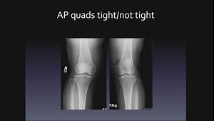 Patellar Instability - It's Really Not That Difficult!