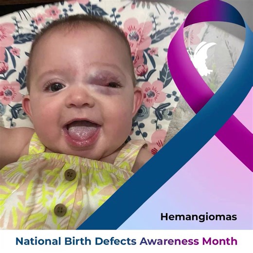 Hemangiomas are common vascular birthmarks that usually appear within the first few weeks of life. They may grow rapidly early on and are often seen on the face or head. In some cases, hemangiomas can affect important functions depending on where they develop, which is why understanding them and knowing when specialized care may be needed is so important for families. As part of National Birth Defects Awareness Month, we’re continuing our educational series to help increase awareness of facial d