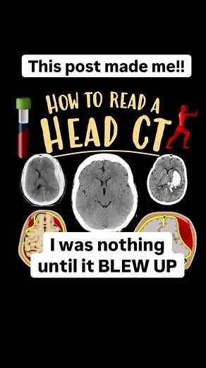 Lea Alhilali, MD on Instagram: "Even if you’re in it for the LONG haul, sometimes it’s good to come up SHORT! Here’s a short post about how to read a head CT If you’re looking at head CTs, this is what you NEED to know! The 3 main things to look for on head CTs are: —Blood —Mass Effect —Stroke 1. Blood CT is just a measure of density & blood is thicker than water, so blood is denser than brain (70% water) on head CT Blood can be: EPIdural: looks lentiform SUBdural: looks crescentic SUBarachnoid: