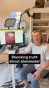 14K views · 125 reactions | Have you ever wondered if you can heal an abscess on your own naturally? This reel explains it all! #abscess #tooth #teeth #dentalwork #oralhealth #dentalhealth #toothabscess | Living Well with Dr. Michelle Jorgensen | Facebook
