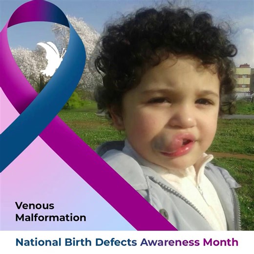 Venous malformations are abnormal veins that develop before birth and often grow gradually over time. They can appear as soft swelling under the skin and may affect areas of the face or jaw. When venous malformations impact comfort or daily function, understanding the condition can help families better navigate care decisions and support. Follow to learn more about the facial differences we’ll be highlighting next. Visit our website to learn more. | Little Baby Face Foundation