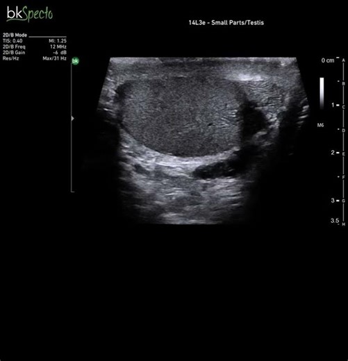 Normal Testicular Ultrasound – Appearance of Healthy Testicular Parenchyma on Scrotal Ultrasound