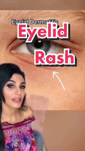 Skin Check: Red Flaky Rash on Eyelids - Causes & Remedies