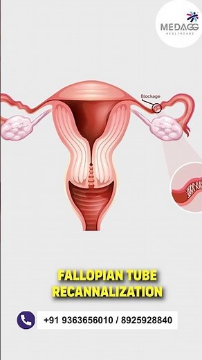 Fallopian Tube Recanalization explained by Dr.Arul !!