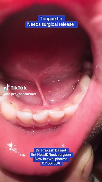 Understanding Tongue Tie and Its Surgical Release
