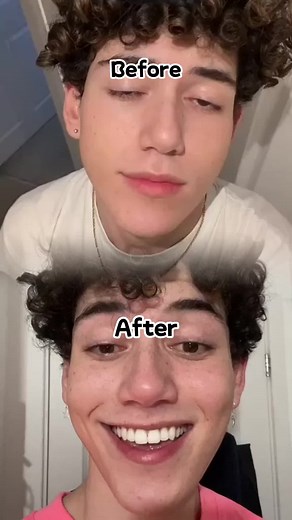 Get a confident and charming smile with SmileKit's teeth whitening strips! Brighten your teeth and boost your confidence with our easy-to-use strips. Try them today!#teethwhitening