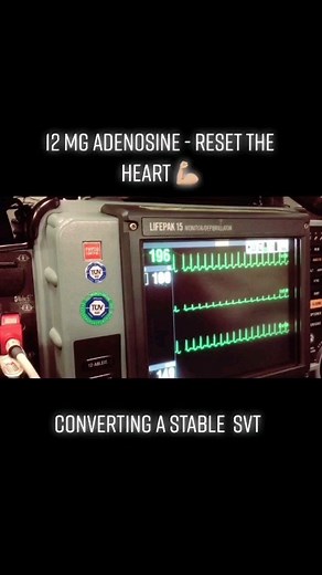 ECG on Instagram: "🫀SVT Termination By Adenosine🫀 #svt #adenosine #ecg #ekg #cardiology #cardiologist #medstudent #electrophysiology #electrocardiogram #paramedic #kardiyoloji #medicalstudent #medik #echocardiology #cardiología #nurse #cardionurse #aritmi #kardiologie #medicinainterna #foamed #Medizin #medicalschool #medisin #Infermieri"