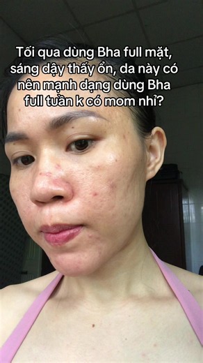 BHA full mặt mỗi tuần có an toàn không? Hướng dẫn dùng BHA cho da mụn
