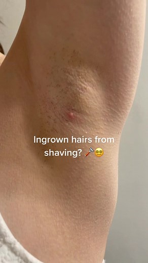 Ingrown hairs are the pits! Help prevent them with this routine! 😅 #ingrownhair #shavingtips #fyp #razorbumps #hairremoval #razorburn #exfoliate